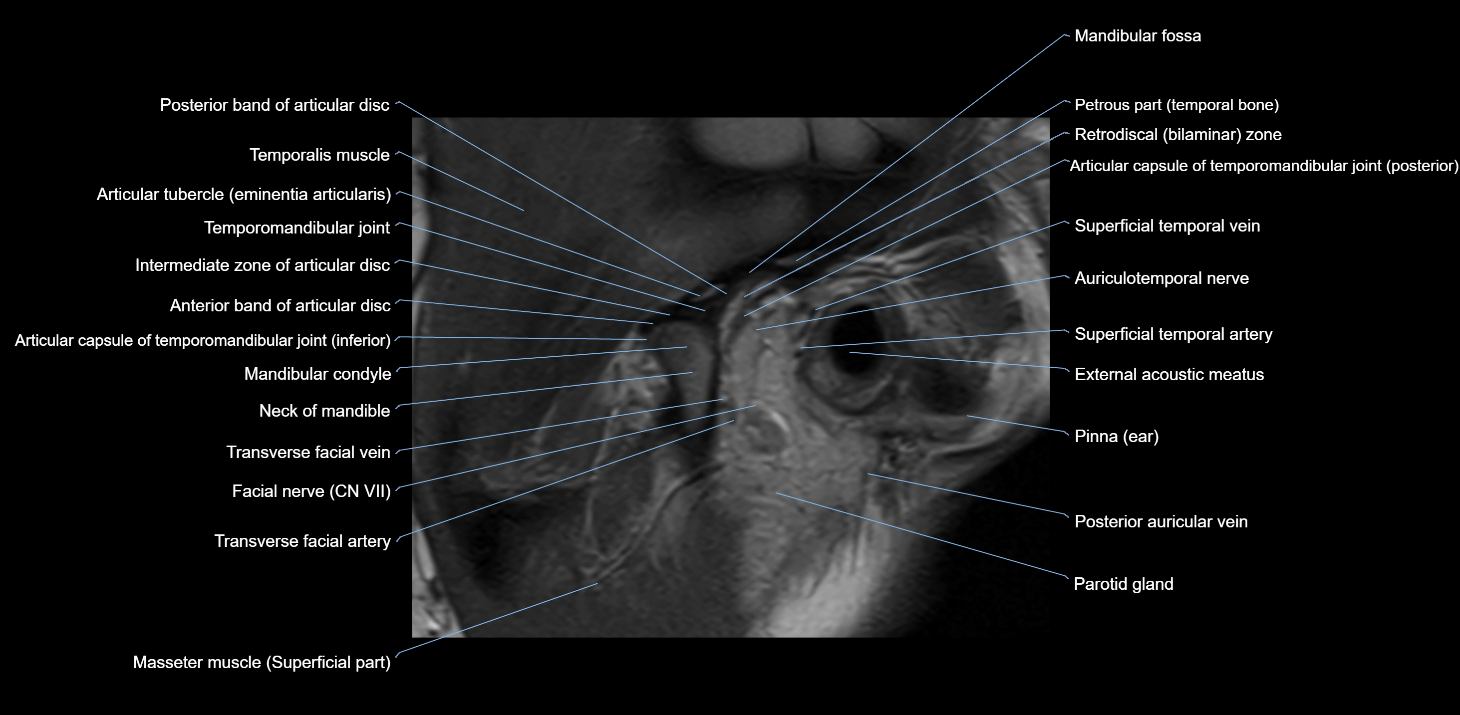 MRI TMJ sagittal open  mouth cross sectional 3T anatomy -img-00001-00005.webp